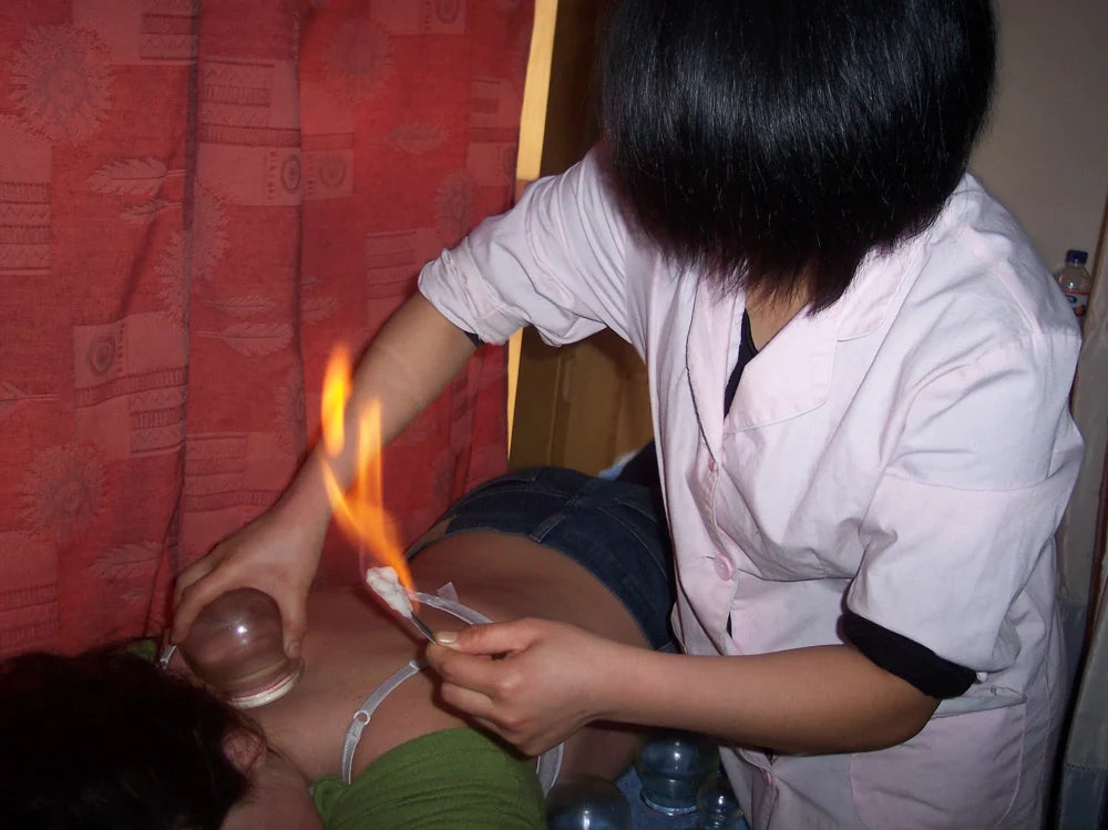 Cupping therapy for tight fascia using traditional fire cupping by practitioner on patient's lower back.
