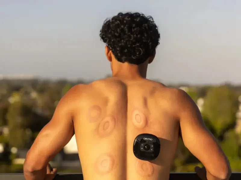 Myofascial release exercises enhanced with cupping marks visible on the back post-therapy.